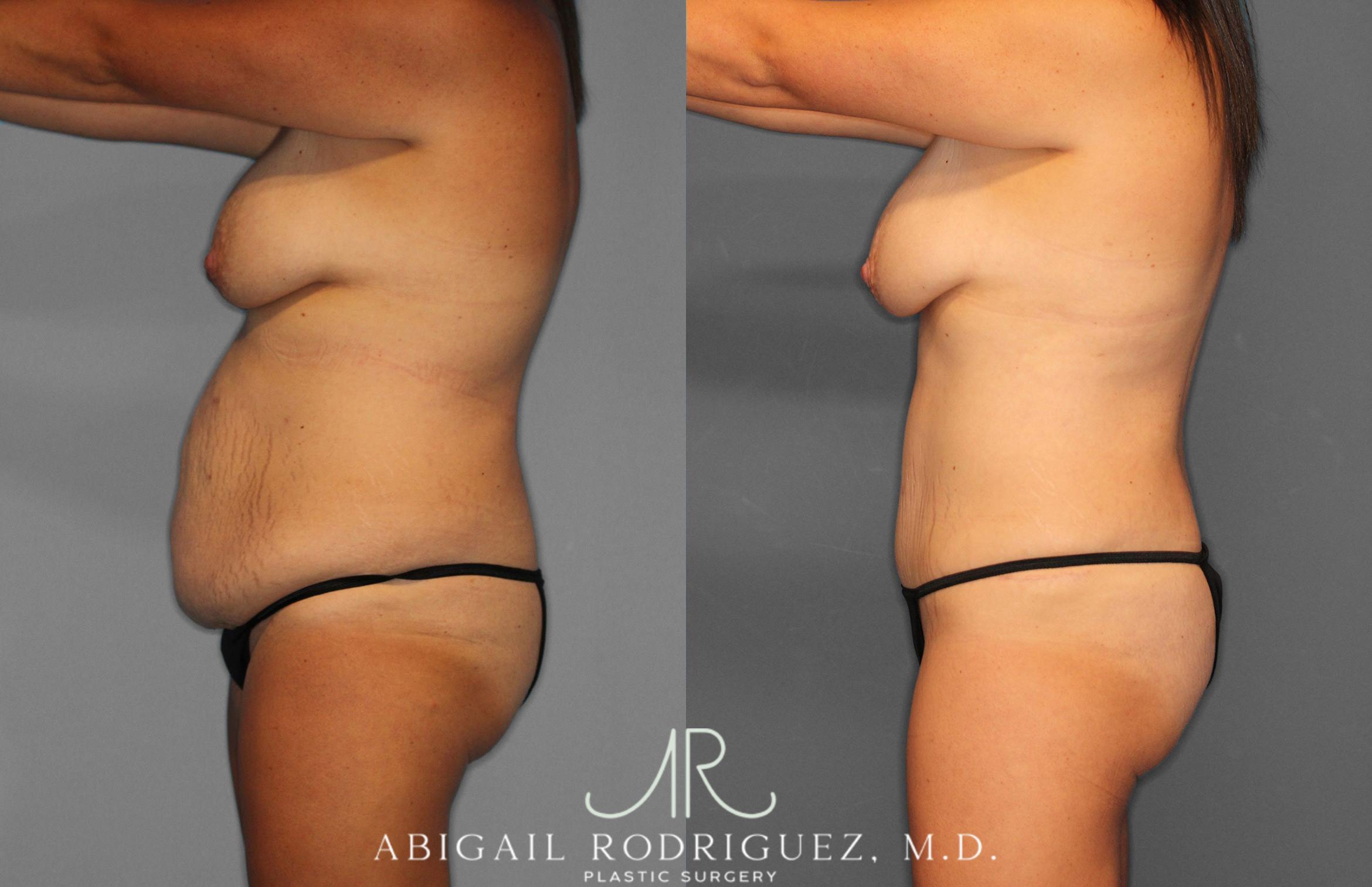 Before & After Tummy Tuck Case 258057 View 3 View in Houston, TX
