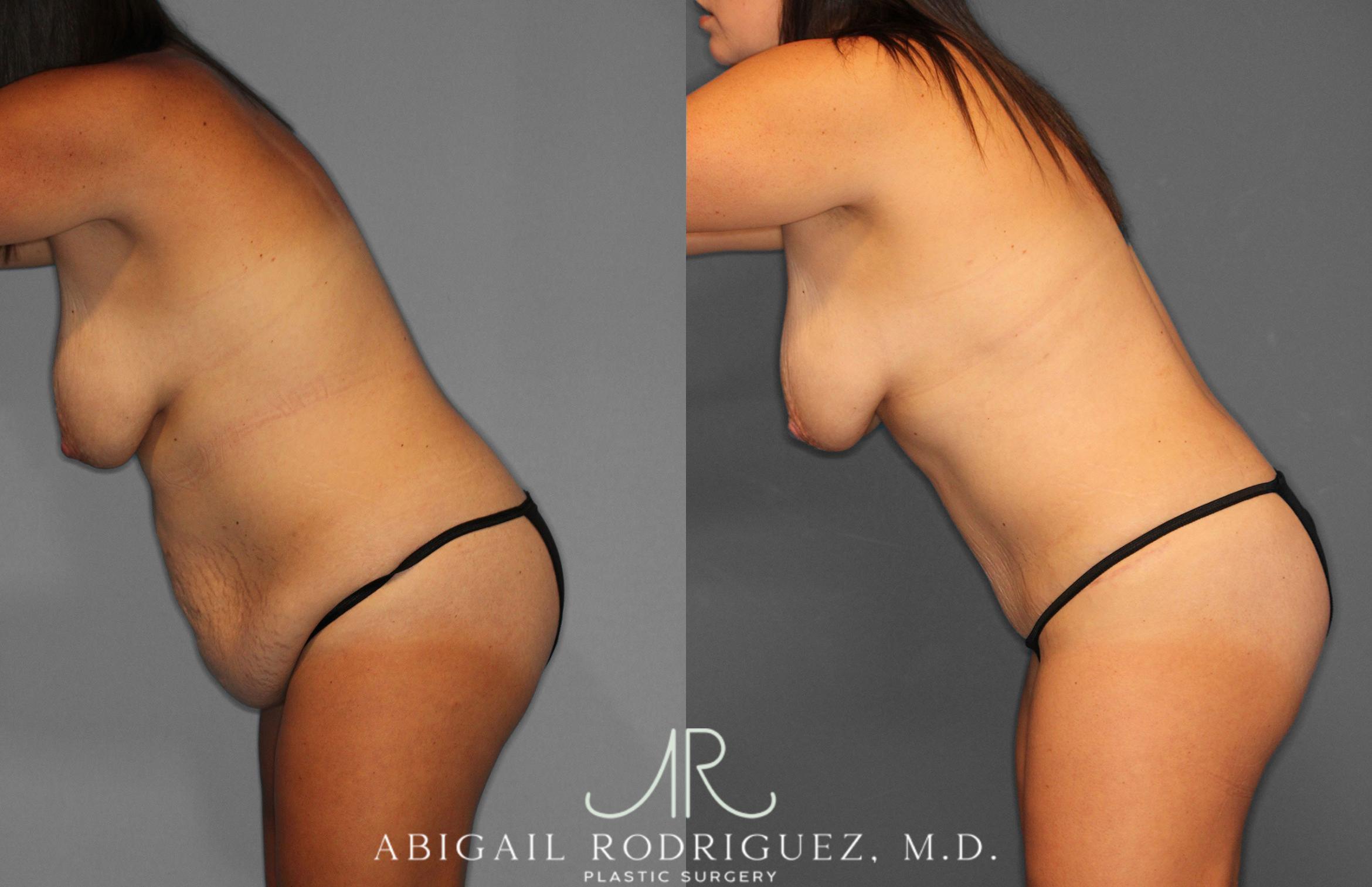 Before & After Tummy Tuck Case 258057 View 4 View in Houston, TX
