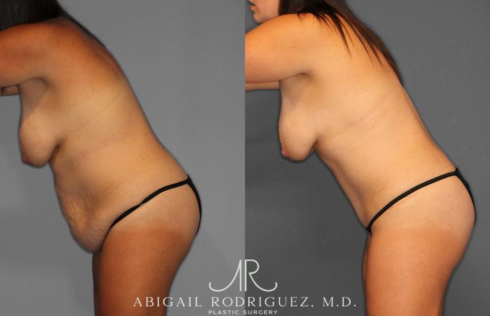 Before & After Tummy Tuck Case 258057 View 4 View in Houston, TX