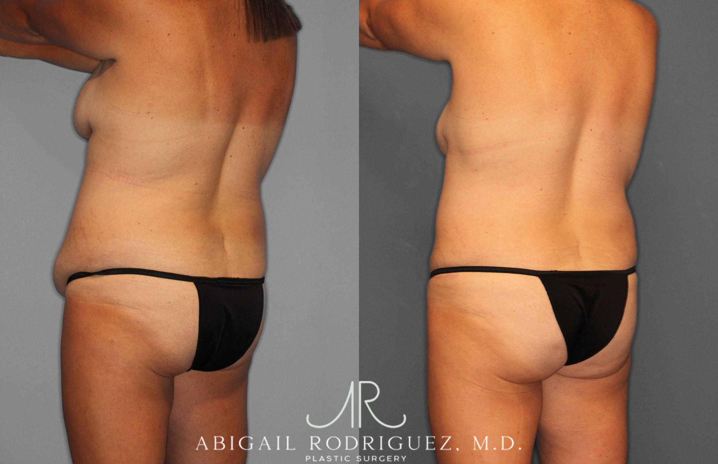 Before & After Tummy Tuck Case 258057 View 5 View in Houston, TX