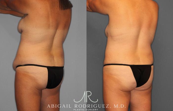 Before & After Tummy Tuck Case 258057 View 5 View in Houston, TX