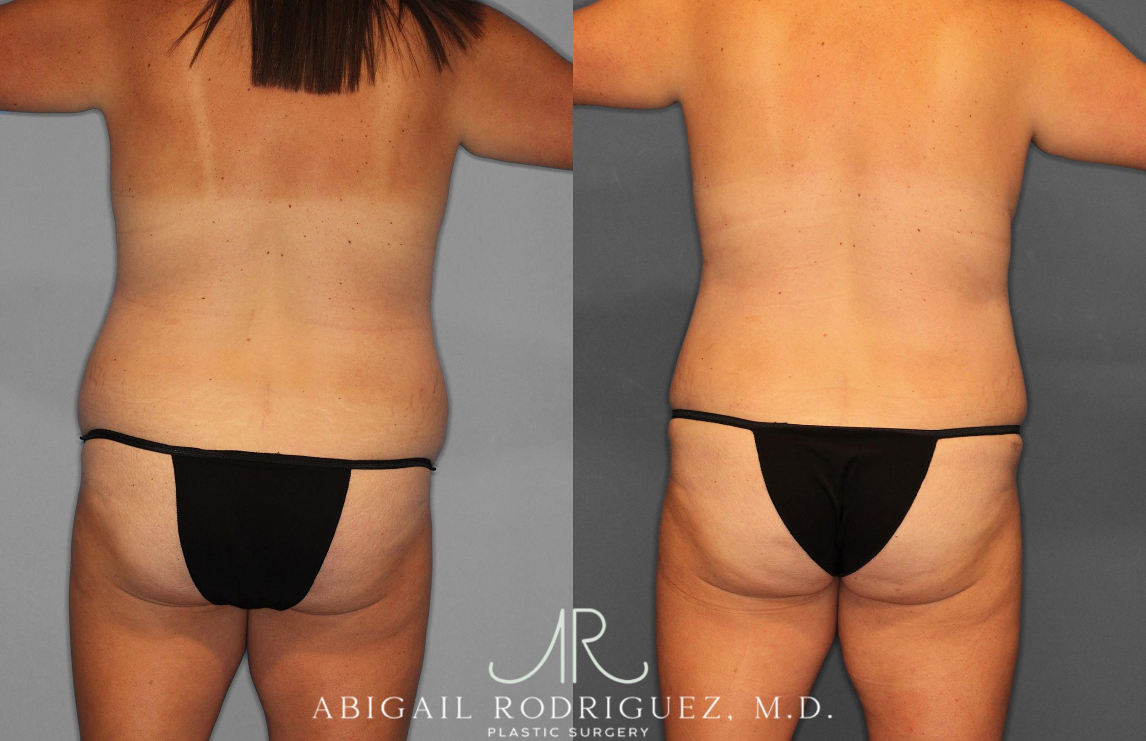 Before & After Tummy Tuck Case 258057 View 6 View in Houston, TX