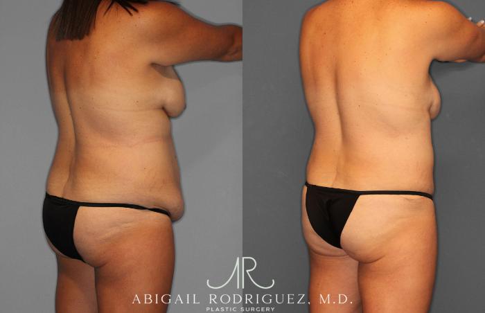 Before & After Tummy Tuck Case 258057 View 7 View in Houston, TX
