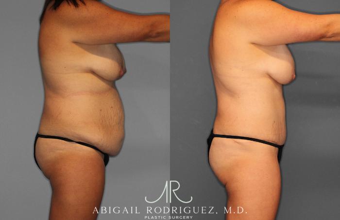 Before & After Tummy Tuck Case 258057 View 8 View in Houston, TX