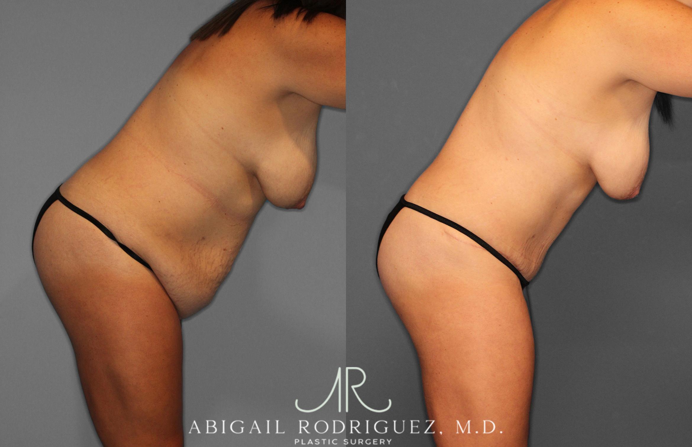 Before & After Tummy Tuck Case 258057 View 9 View in Houston, TX