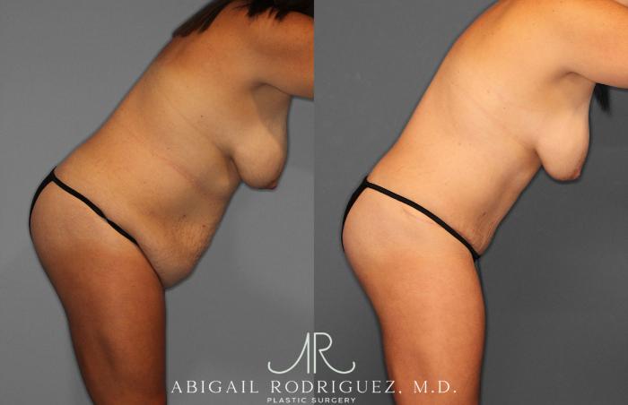 Before & After Tummy Tuck Case 258057 View 9 View in Houston, TX