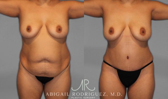 Before & After Tummy Tuck Case 258075 View 1 View in Houston, TX