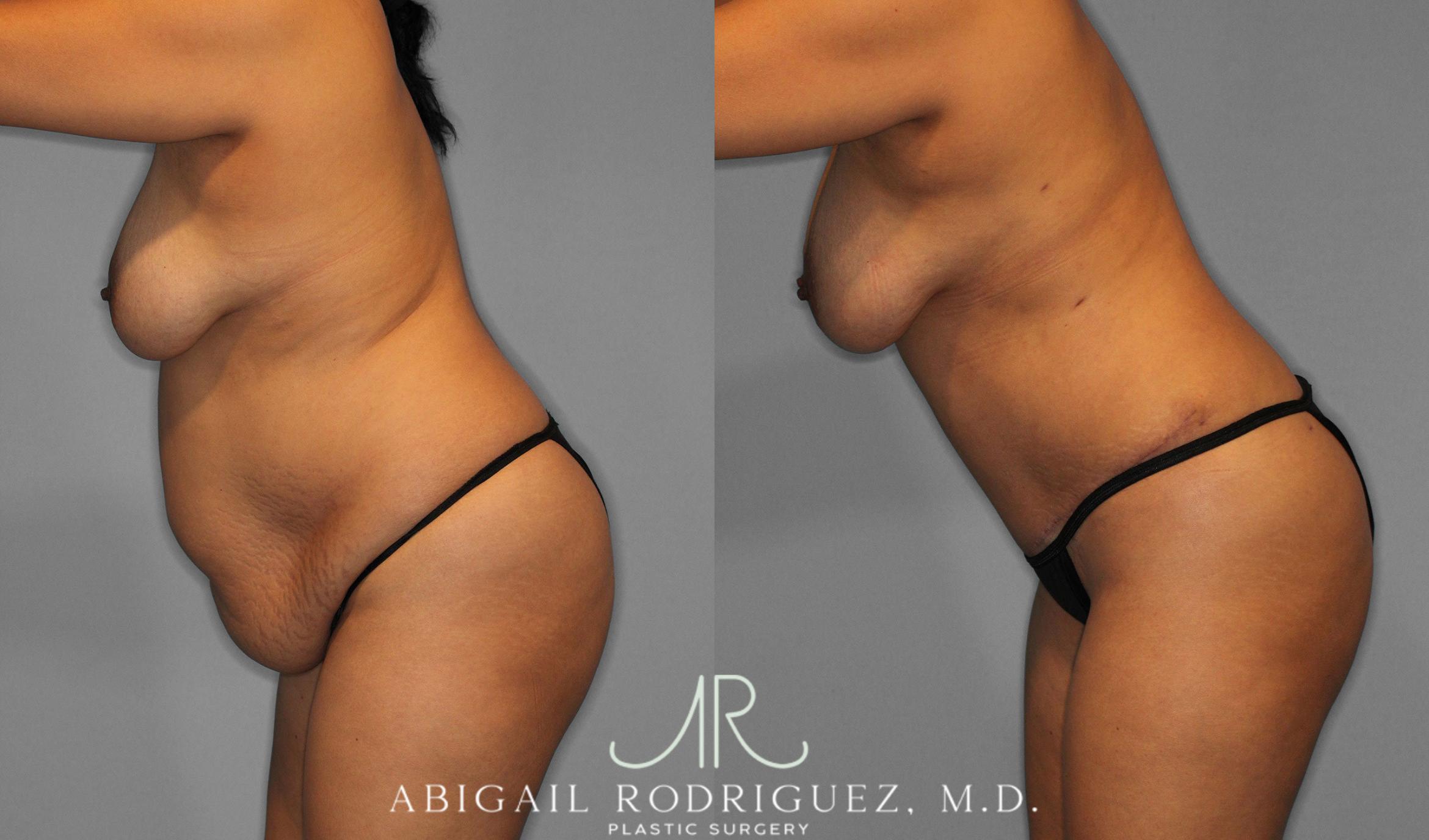 Before & After Tummy Tuck Case 258075 View 10 View in Houston, TX