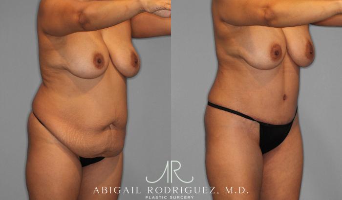 Before & After Tummy Tuck Case 258075 View 2 View in Houston, TX
