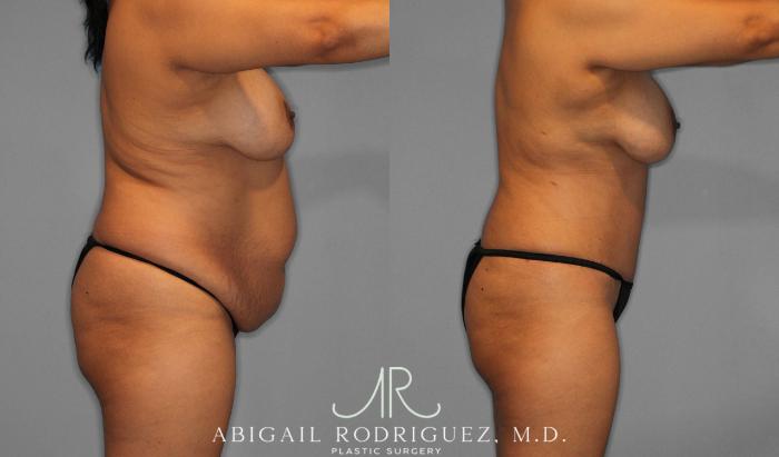 Before & After Tummy Tuck Case 258075 View 3 View in Houston, TX