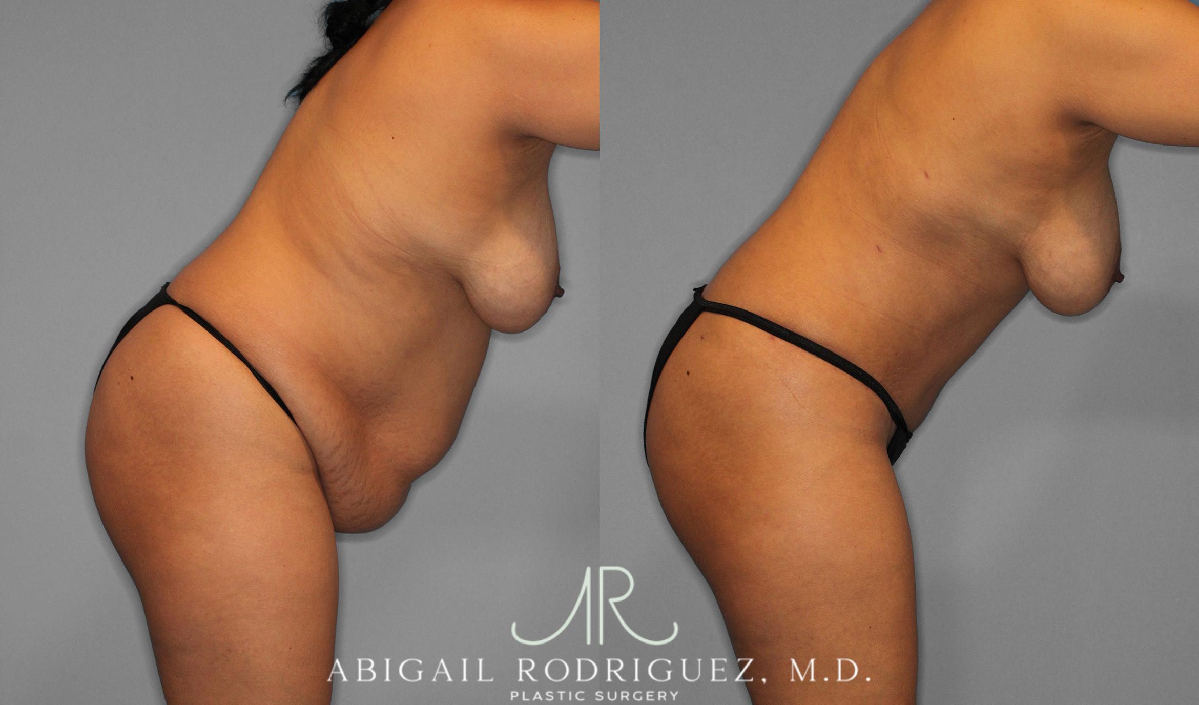 Before & After Tummy Tuck Case 258075 View 4 View in Houston, TX