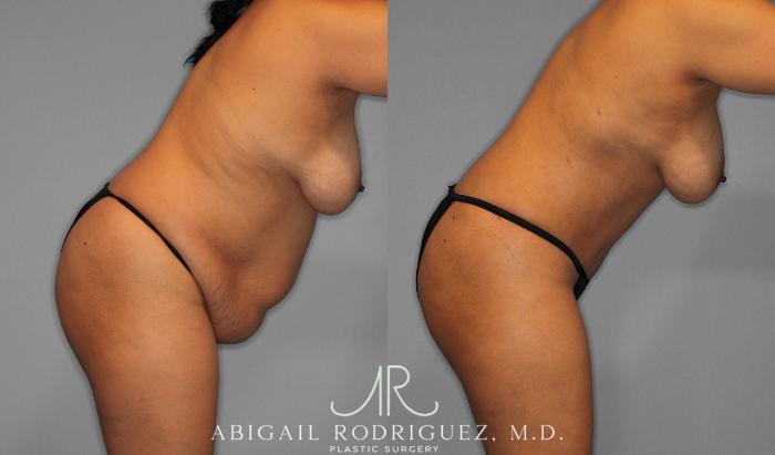 Before & After Tummy Tuck Case 258075 View 4 View in Houston, TX
