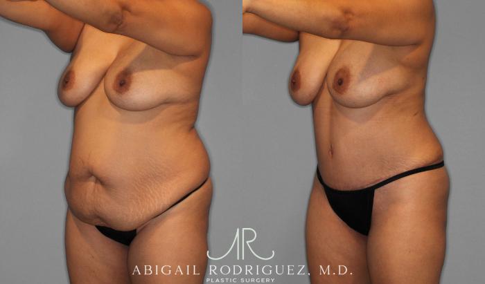 Before & After Tummy Tuck Case 258075 View 5 View in Houston, TX