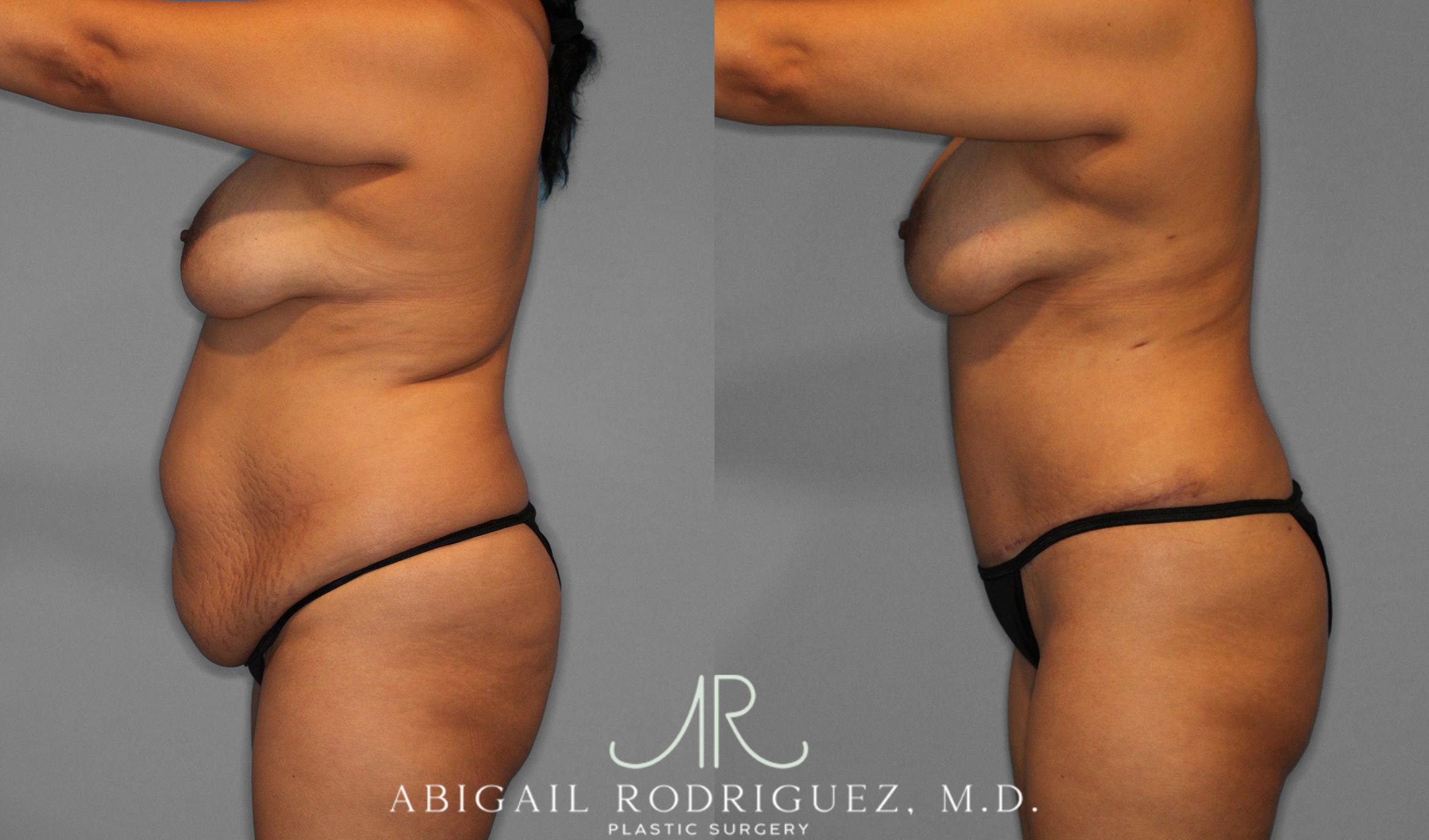Before & After Tummy Tuck Case 258075 View 6 View in Houston, TX
