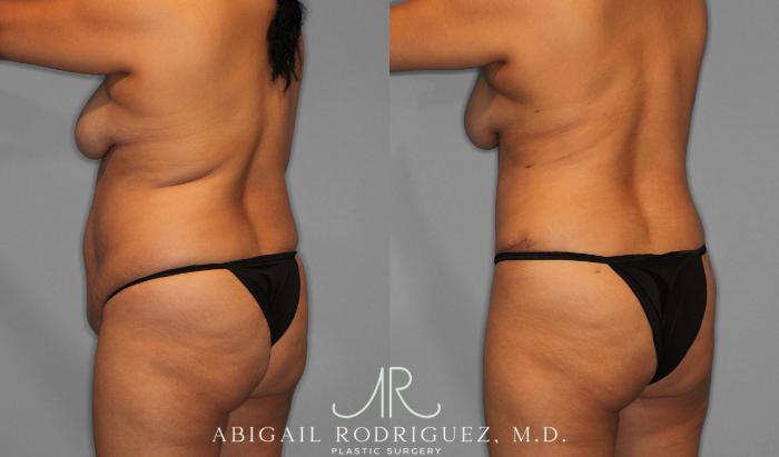Before & After Tummy Tuck Case 258075 View 7 View in Houston, TX