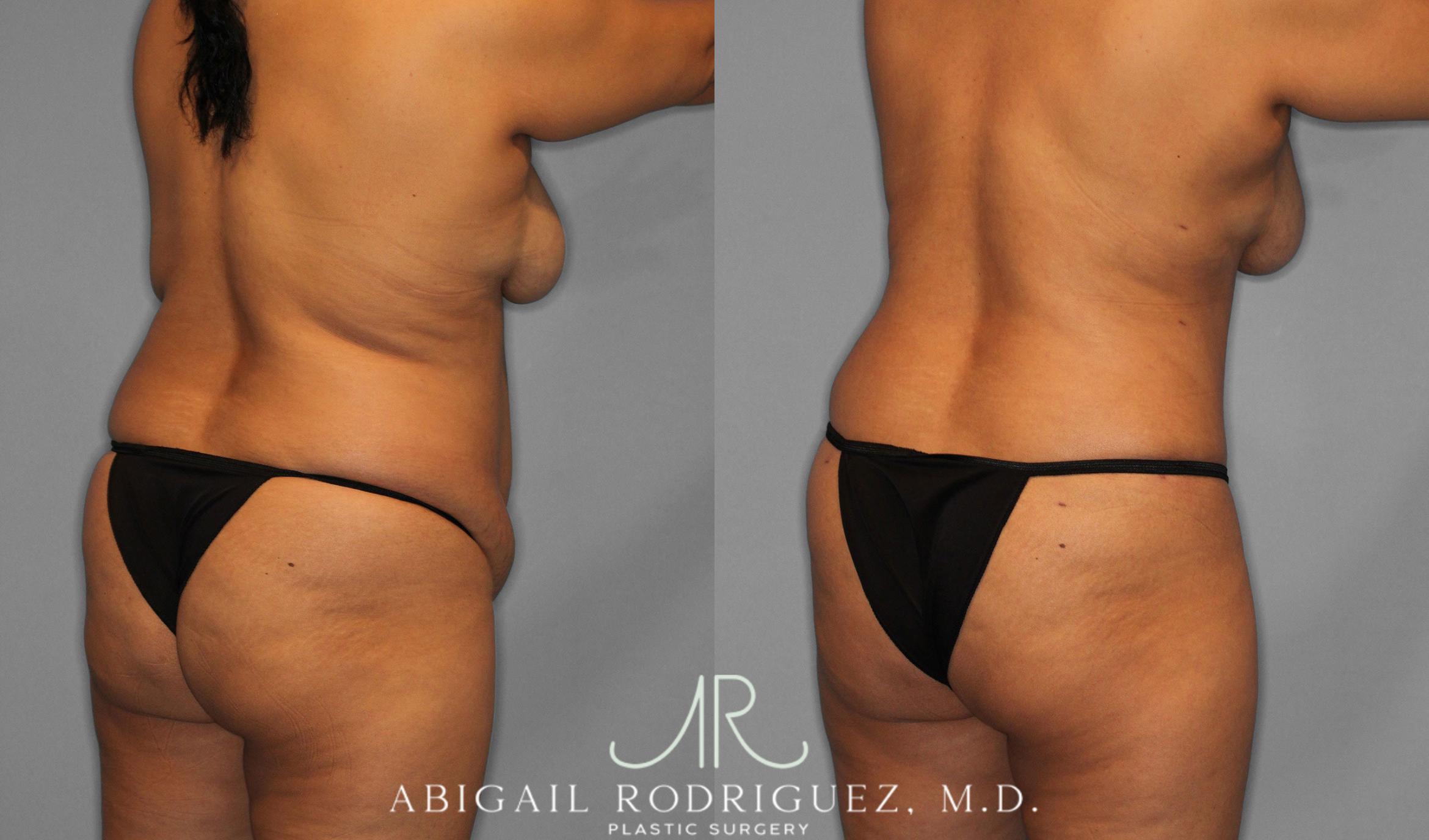 Before & After Tummy Tuck Case 258075 View 8 View in Houston, TX