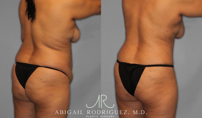 Before & After Tummy Tuck Case 258075 View 8 View in Houston, TX