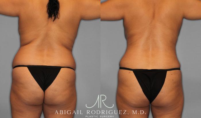 Before & After Tummy Tuck Case 258075 View 9 View in Houston, TX