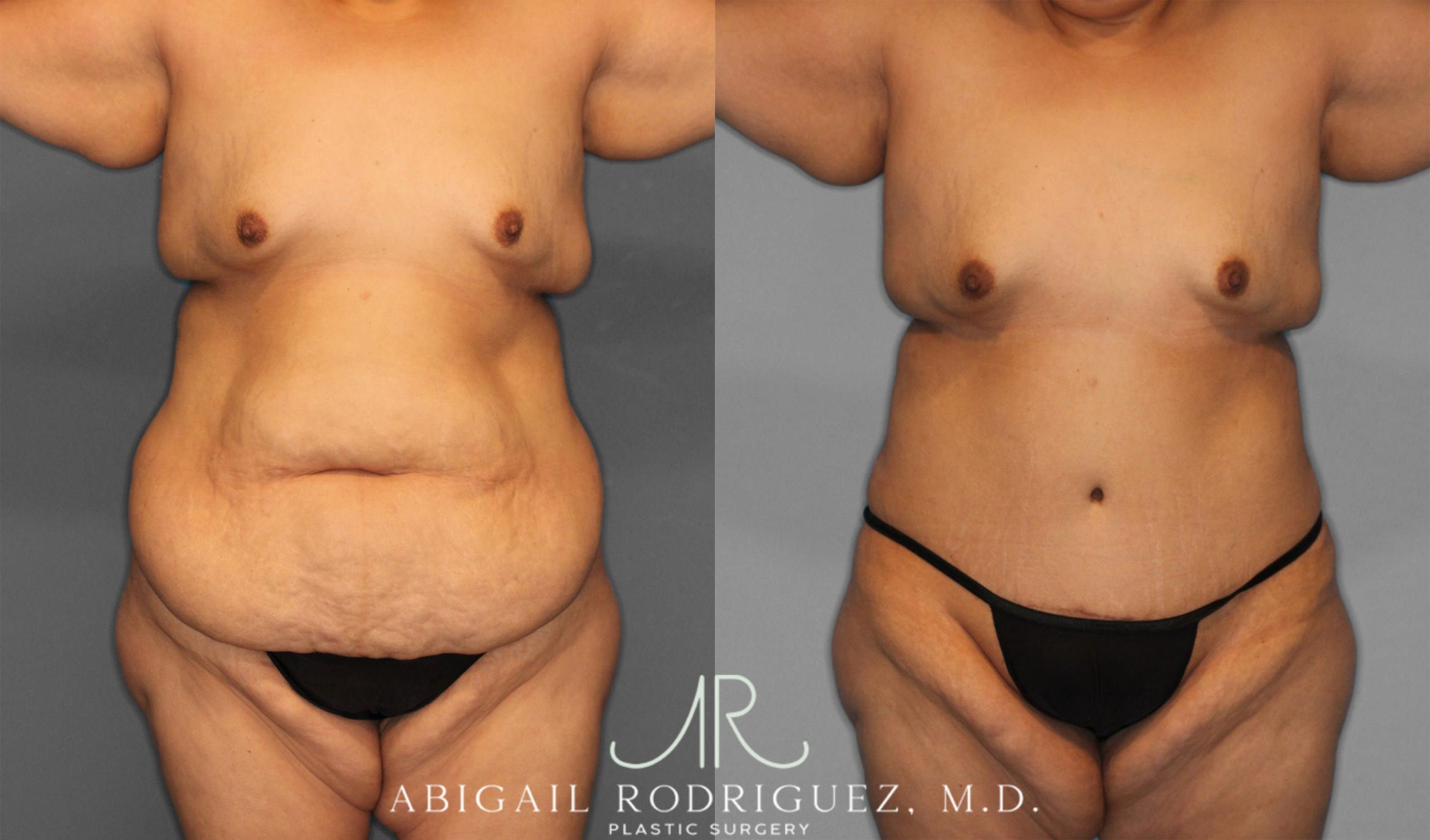Before & After Tummy Tuck Case 258087 View 1 View in Houston, TX