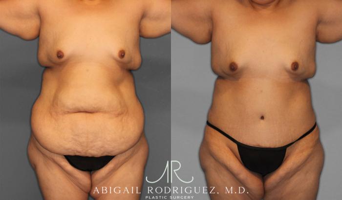 Before & After Tummy Tuck Case 258087 View 1 View in Houston, TX
