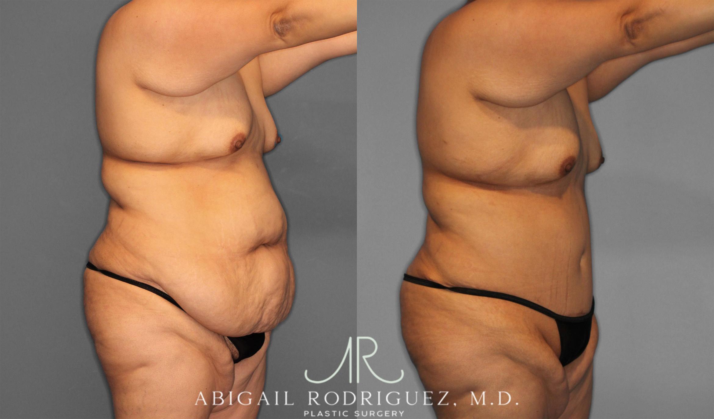 Before & After Tummy Tuck Case 258087 View 10 View in Houston, TX