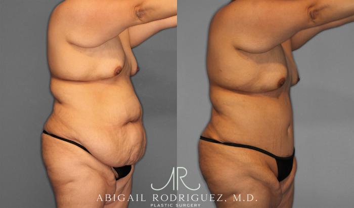 Before & After Tummy Tuck Case 258087 View 10 View in Houston, TX
