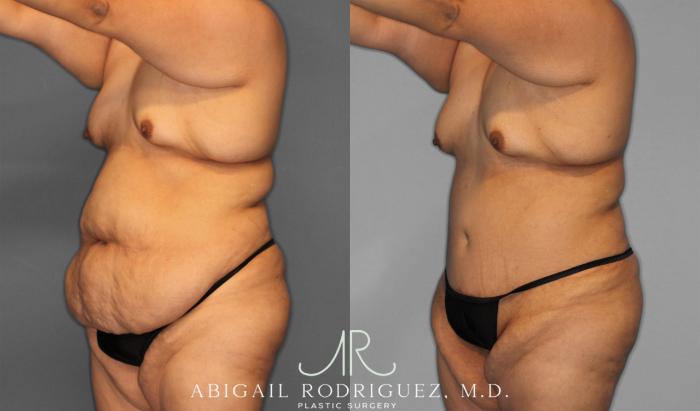 Before & After Tummy Tuck Case 258087 View 2 View in Houston, TX