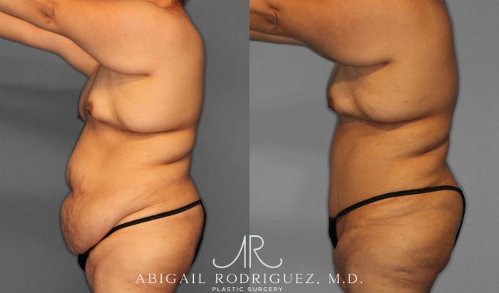 Before & After Tummy Tuck Case 258087 View 3 View in Houston, TX