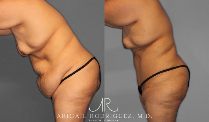 Before & After Tummy Tuck Case 258087 View 4 View in Houston, TX