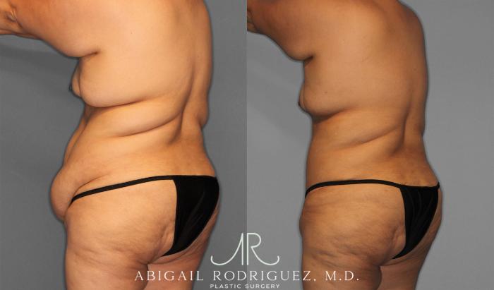 Before & After Tummy Tuck Case 258087 View 5 View in Houston, TX