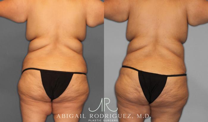 Before & After Tummy Tuck Case 258087 View 6 View in Houston, TX