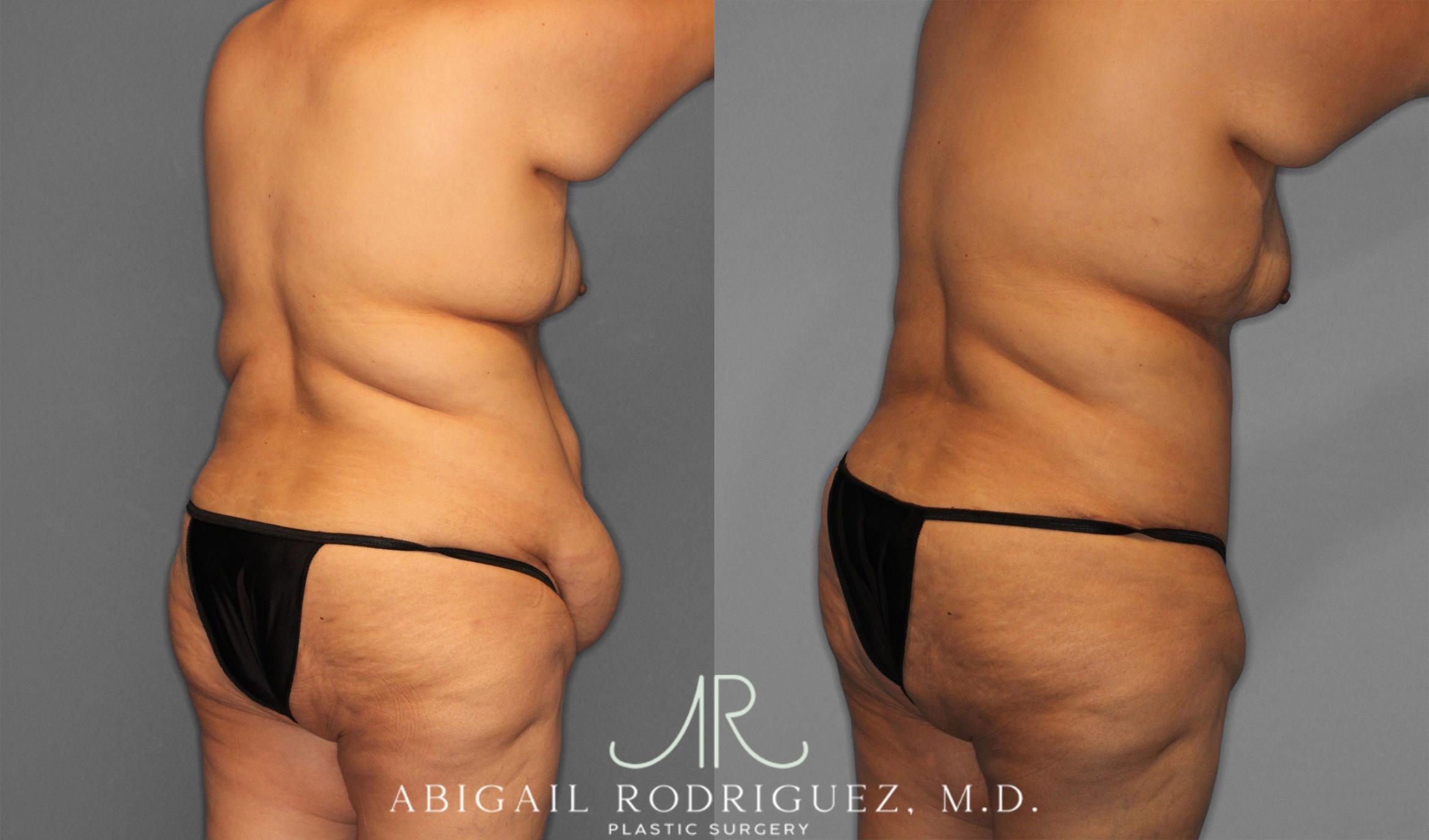 Before & After Tummy Tuck Case 258087 View 7 View in Houston, TX