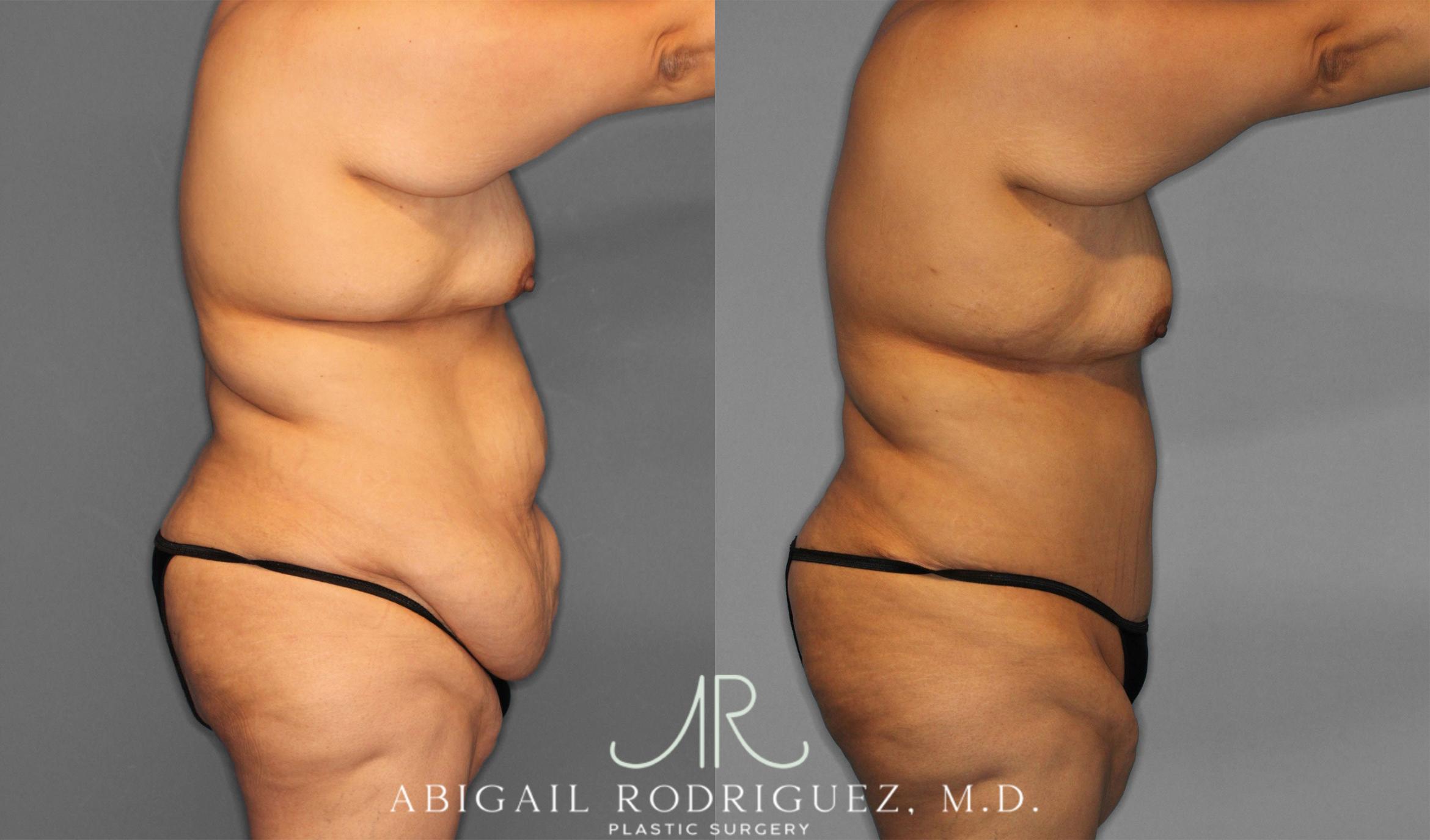 Before & After Tummy Tuck Case 258087 View 8 View in Houston, TX