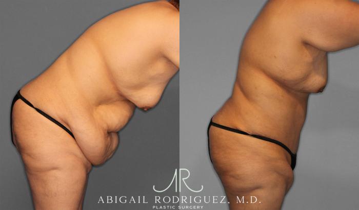 Before & After Tummy Tuck Case 258087 View 9 View in Houston, TX
