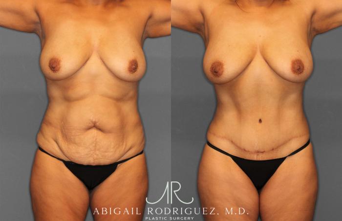 Before & After Tummy Tuck Case 258150 View 1 View in Houston, TX