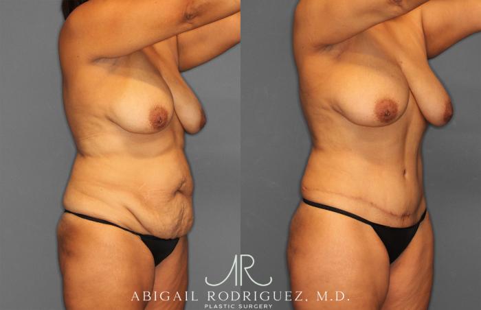Before & After Tummy Tuck Case 258150 View 10 View in Houston, TX