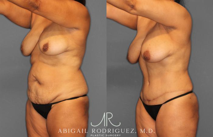 Before & After Tummy Tuck Case 258150 View 2 View in Houston, TX