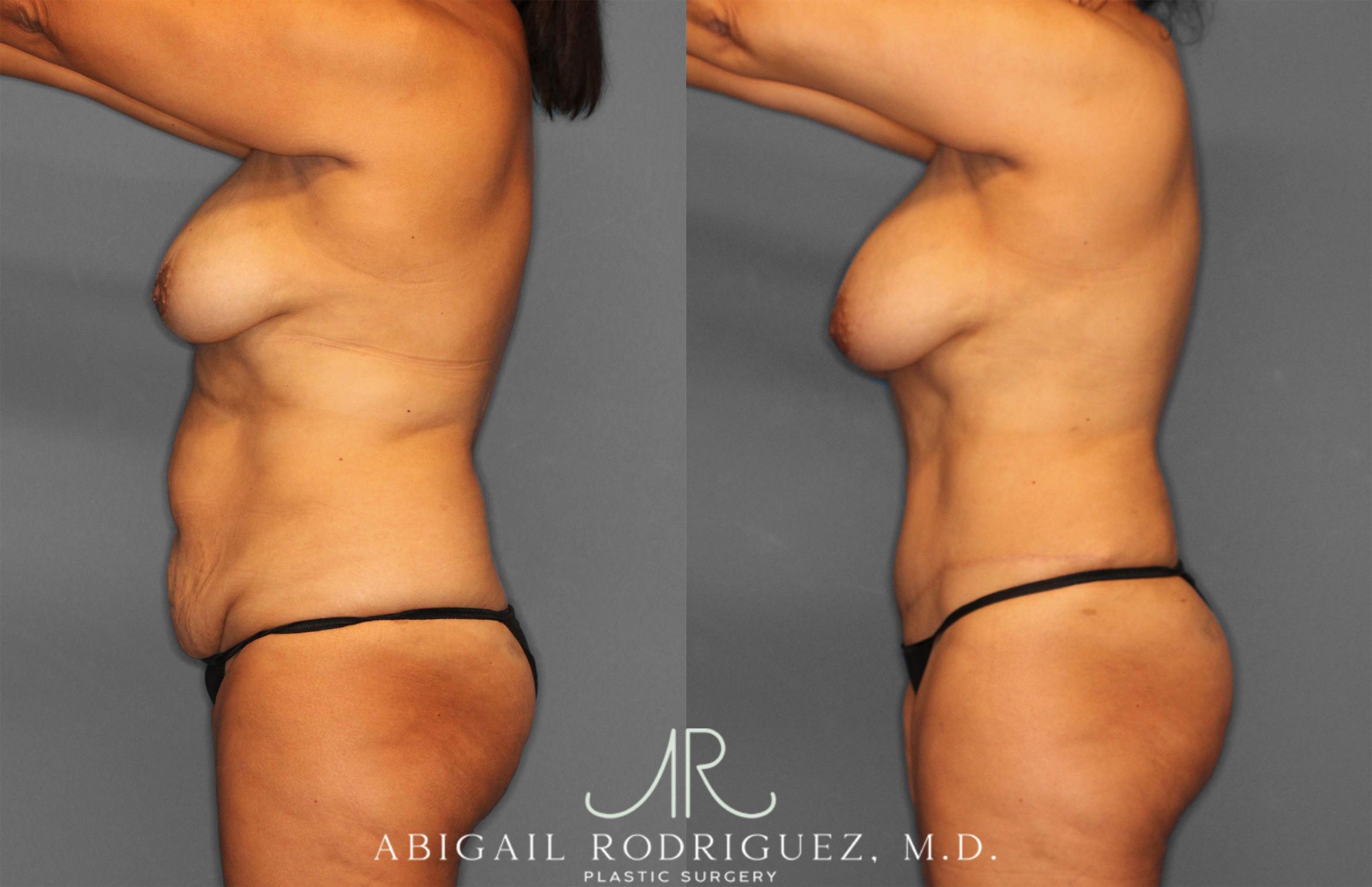Before & After Tummy Tuck Case 258150 View 3 View in Houston, TX