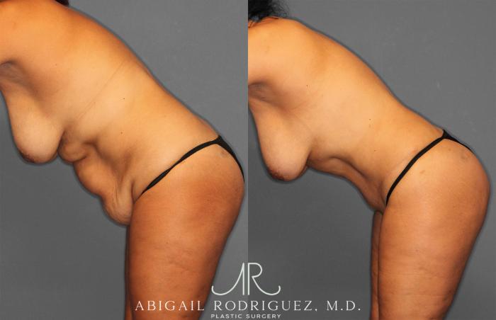 Before & After Tummy Tuck Case 258150 View 4 View in Houston, TX