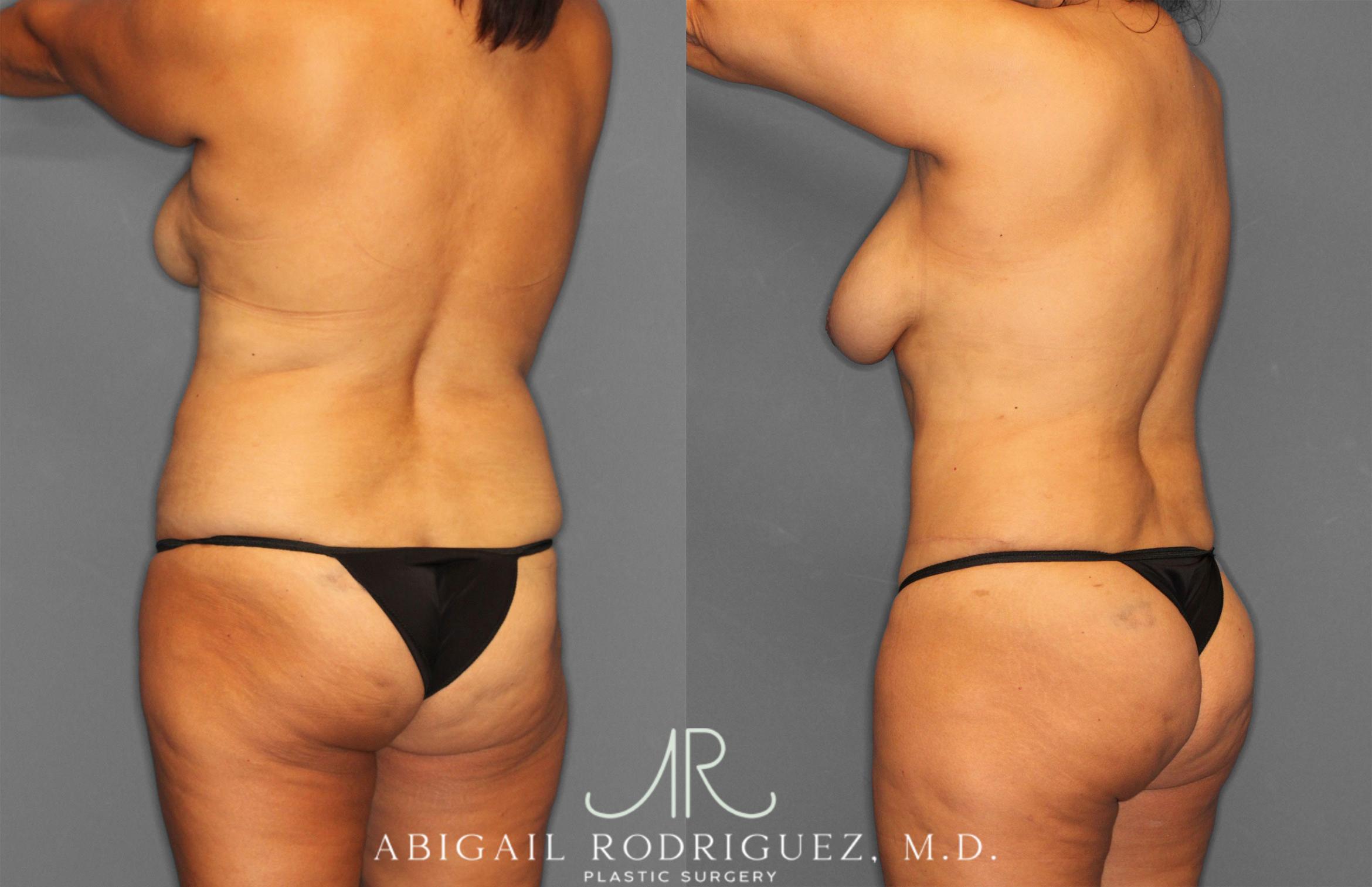 Before & After Tummy Tuck Case 258150 View 5 View in Houston, TX
