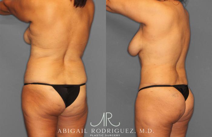 Before & After Tummy Tuck Case 258150 View 5 View in Houston, TX