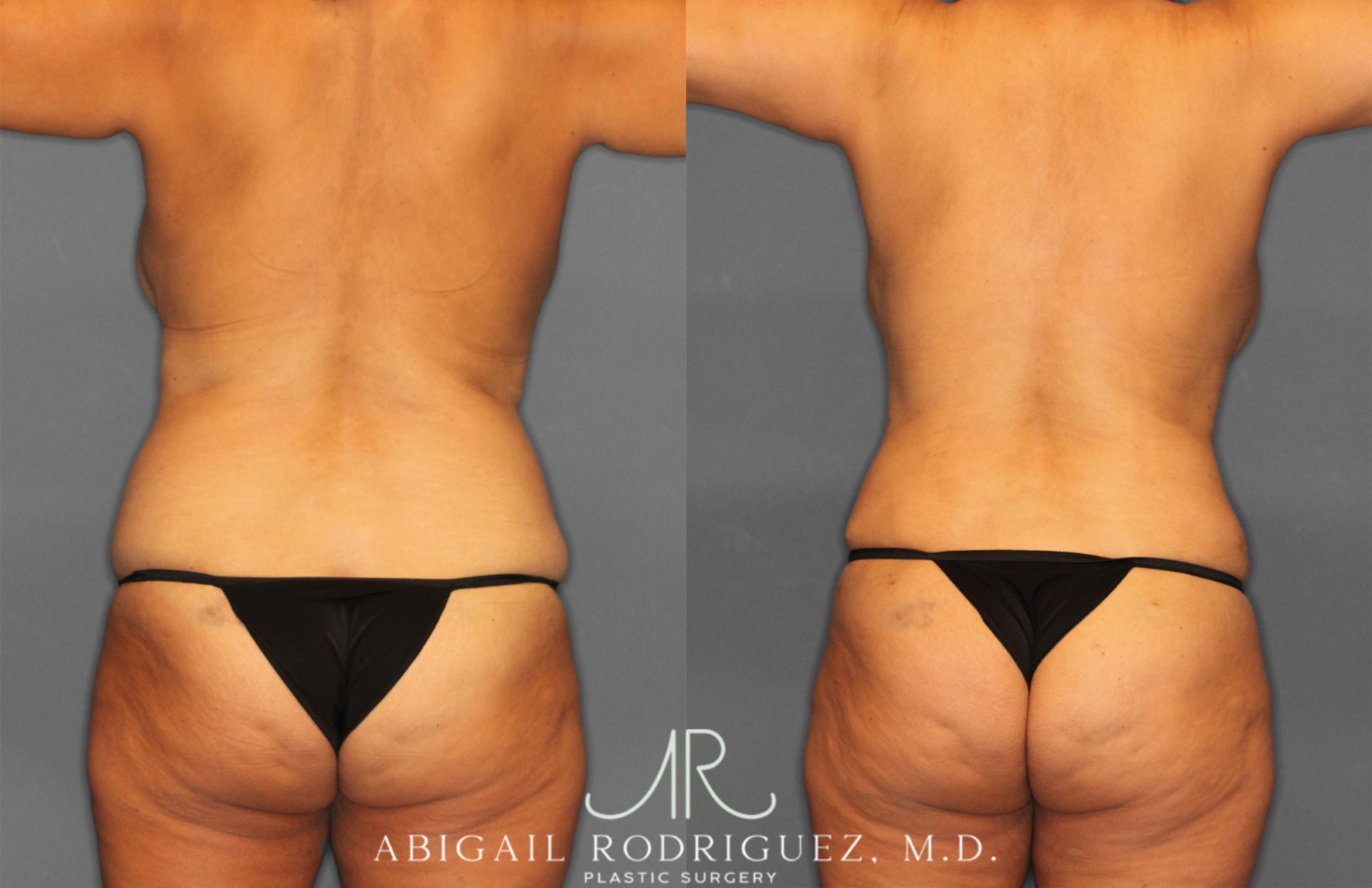Before & After Tummy Tuck Case 258150 View 6 View in Houston, TX