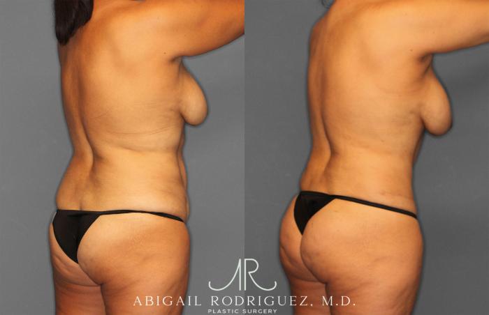 Before & After Tummy Tuck Case 258150 View 7 View in Houston, TX