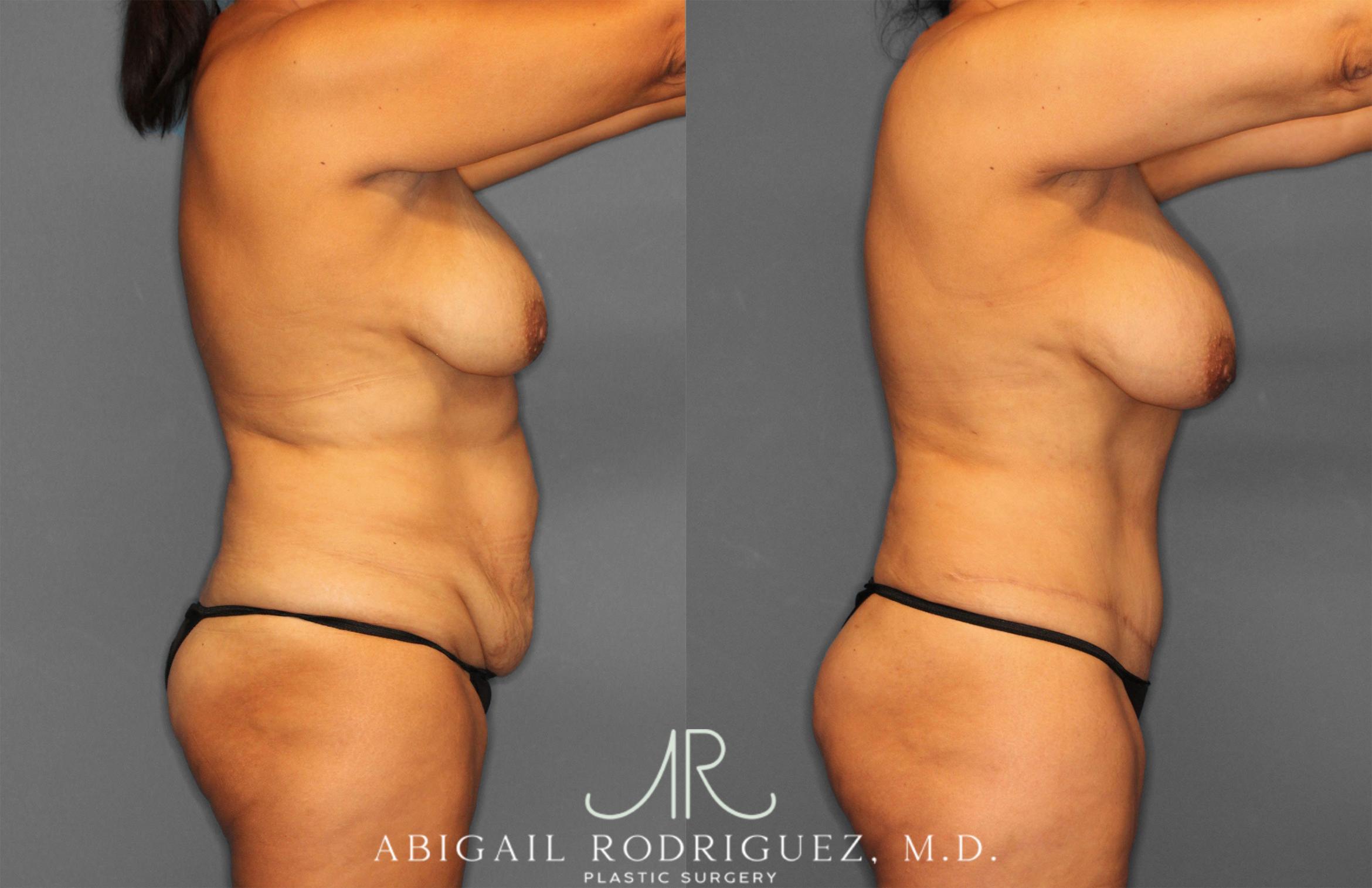 Before & After Tummy Tuck Case 258150 View 8 View in Houston, TX