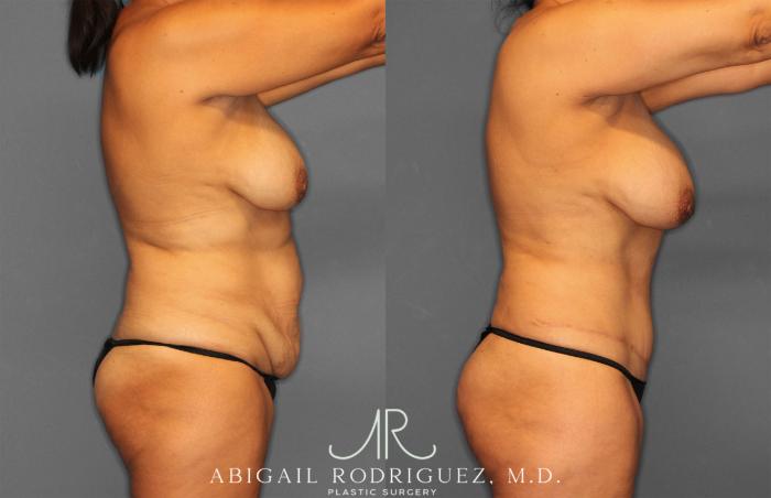 Before & After Tummy Tuck Case 258150 View 8 View in Houston, TX