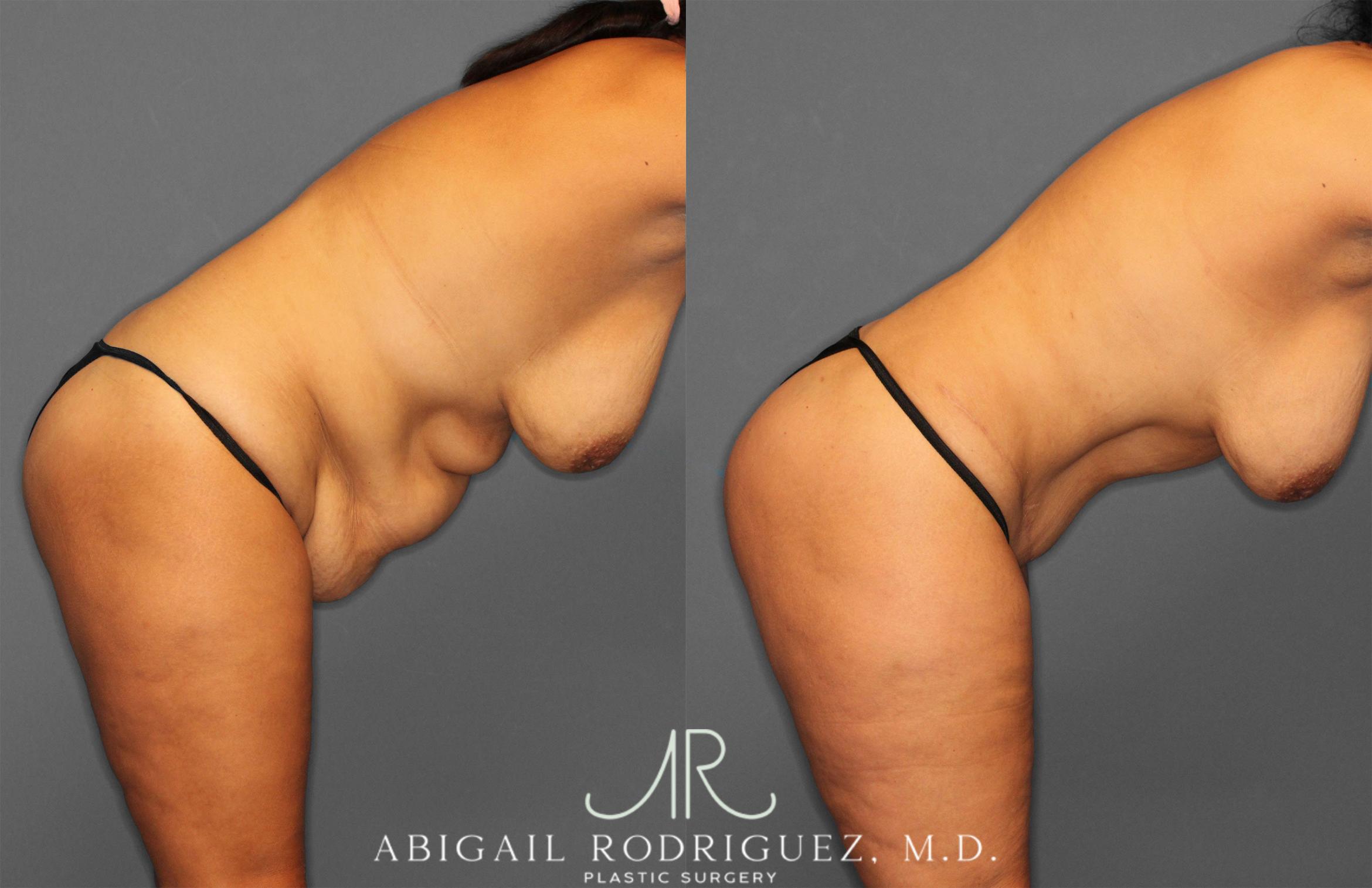 Before & After Tummy Tuck Case 258150 View 9 View in Houston, TX