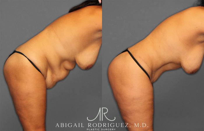 Before & After Tummy Tuck Case 258150 View 9 View in Houston, TX