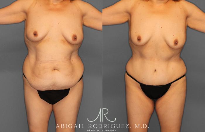 Before & After Tummy Tuck Case 258177 View 1 View in Houston, TX