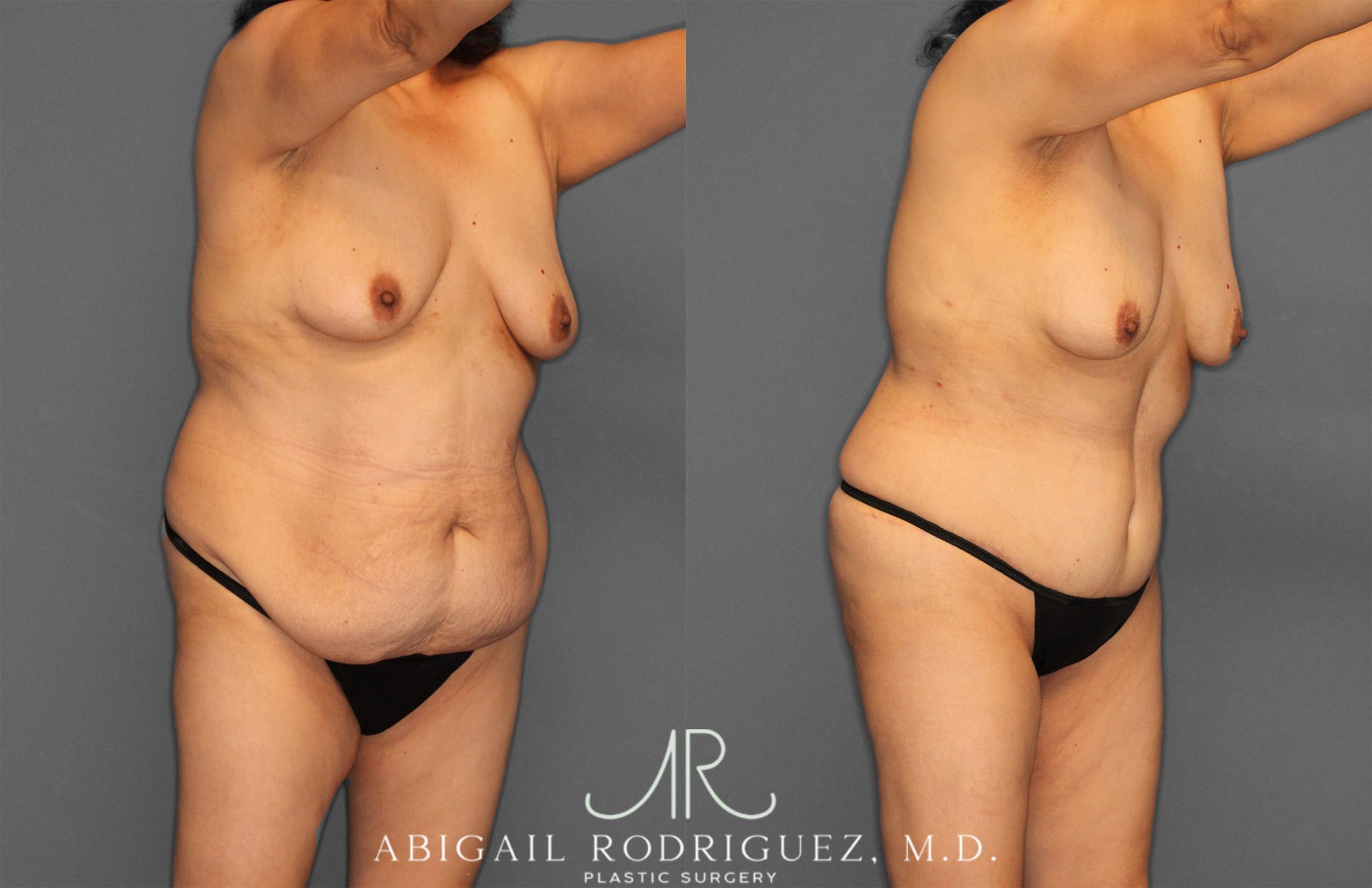 Before & After Tummy Tuck Case 258177 View 10 View in Houston, TX
