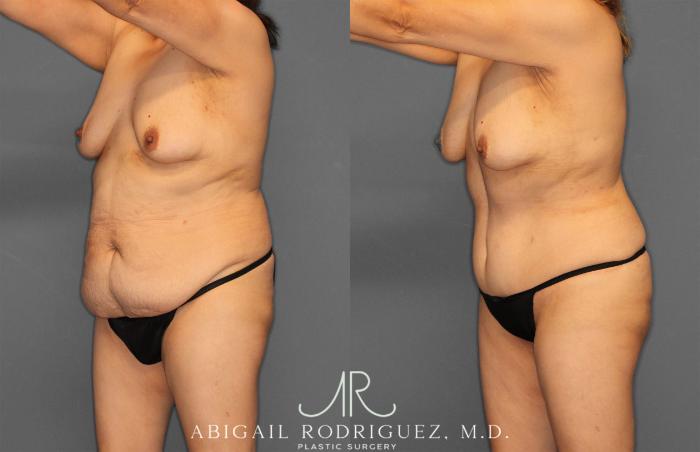 Before & After Tummy Tuck Case 258177 View 2 View in Houston, TX
